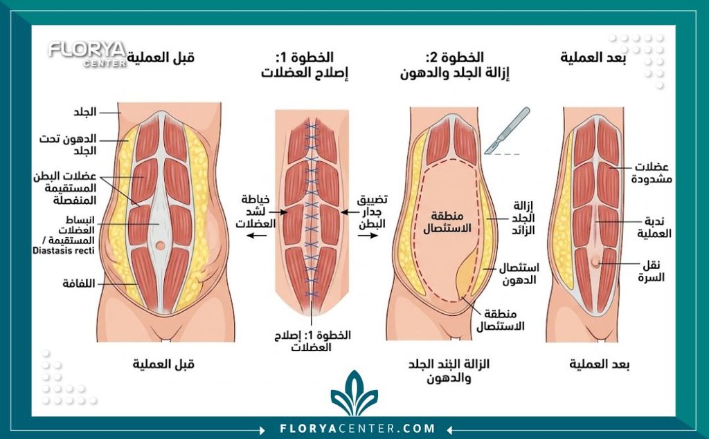 رسم توضيحي تشريحي يشرح خطوات عملية شد البطن الكامل وإصلاح العضلات المنفصلة.