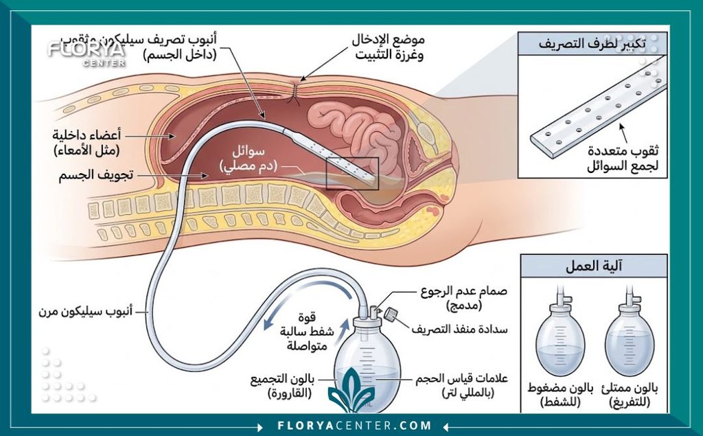 طريقة العناية بأنابيب التصريف (الدرنقة) في المنزل 2 رسم توضيحي طبي يبين أجزاء أنبوب التصريف الجراحي الدرنقة وموقعها في الجسم.