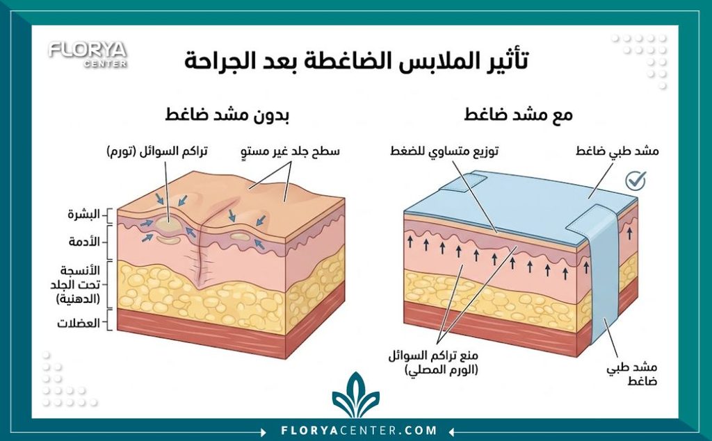 رسم توضيحي طبي يبين أهمية لبس المشد بعد العملية لمنع تكتل السوائل وتجنب تعرج الجلد.