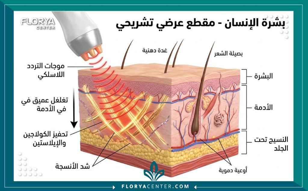 رسم توضيحي طبي يوضح كيف تعمل موجات الراديو فريكونسي لشد ترهلات الجلد وتحفيز الكولاجين.