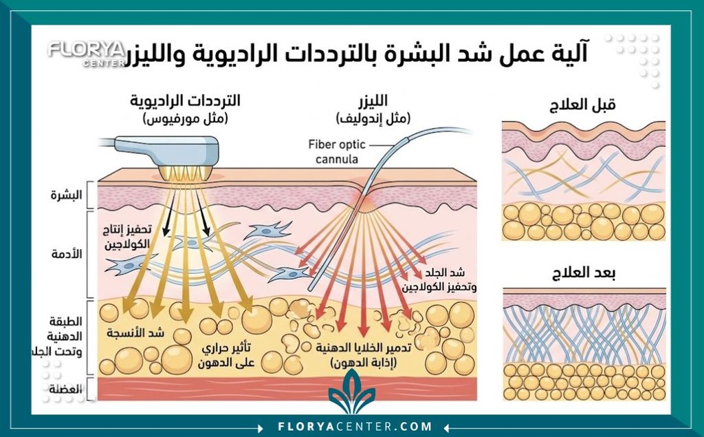 رسم توضيحي طبي لطبقات الجلد يوضح آلية عمل أجهزة شد الجسم غير الجراحية وتحفيز الكولاجين.
