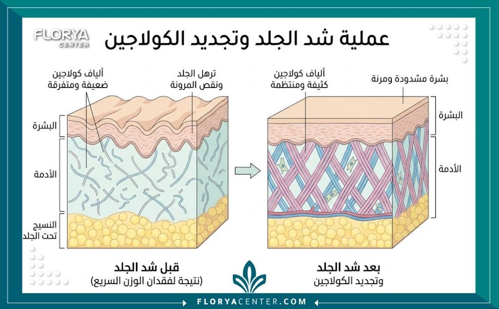 رسم توضيحي طبي لطبقات الجلد يبرز أسباب الترهل المفاجئ بعد التخسيس وكيفية تحفيز الكولاجين لشد الجلد.