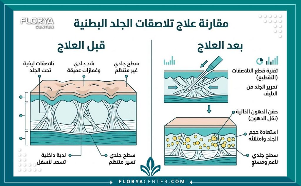 علاج الالتصاقات الجلدية بعد الجراحة 3 إنفوجرافيك يقارن بين شكل البطن قبل وبعد علاج الالتصاقات الجلدية بعد الجراحة وتحرير الندبات.