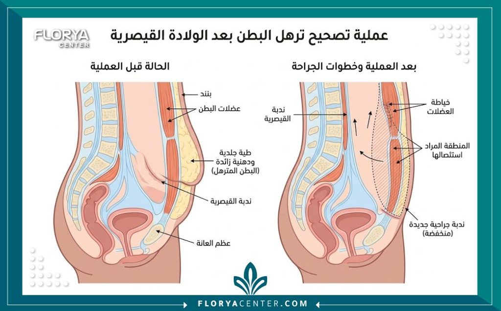 رسم توضيحي طبي يوضح تشريح البطن السفلي وكيفية علاج الطية المتدلية فوق ندبة القيصرية جراحياً.