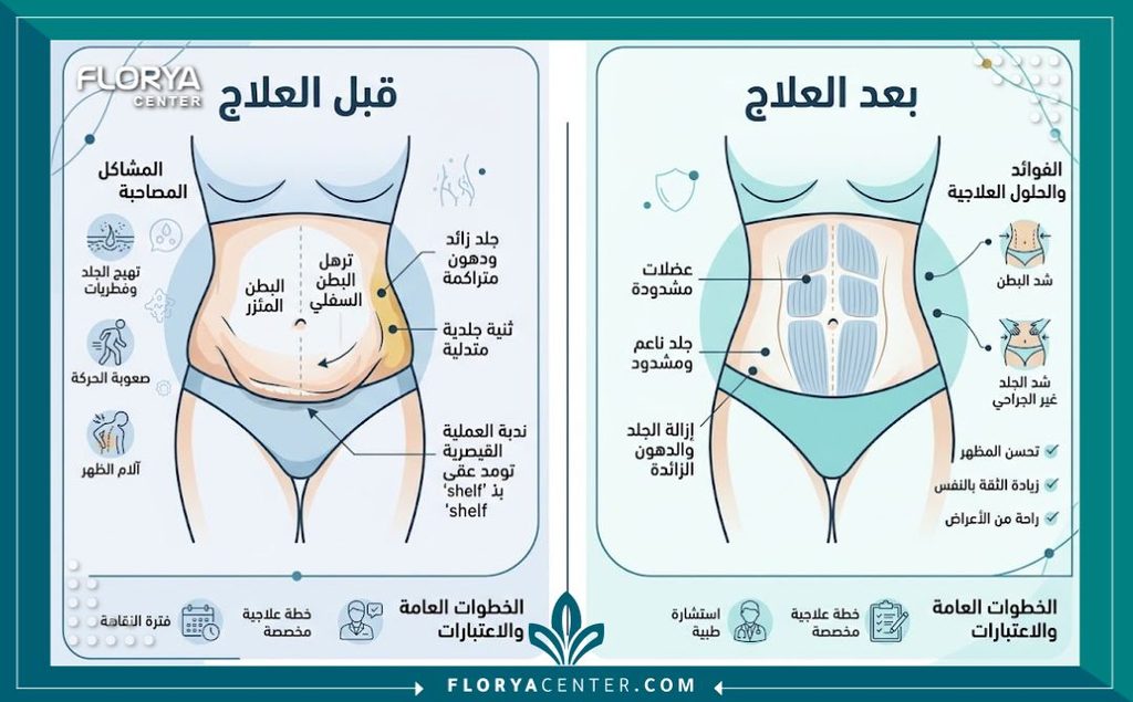 إنفوجرافيك يقارن بين شكل البطن السفلي قبل وبعد التخلص من الترهل الشريطي وشد الجلد.