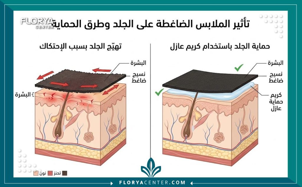 رسم توضيحي طبي لطبقات الجلد يوضح أسباب احتكاك البشرة تحت المشد وكيفية عمل الكريم العازل.