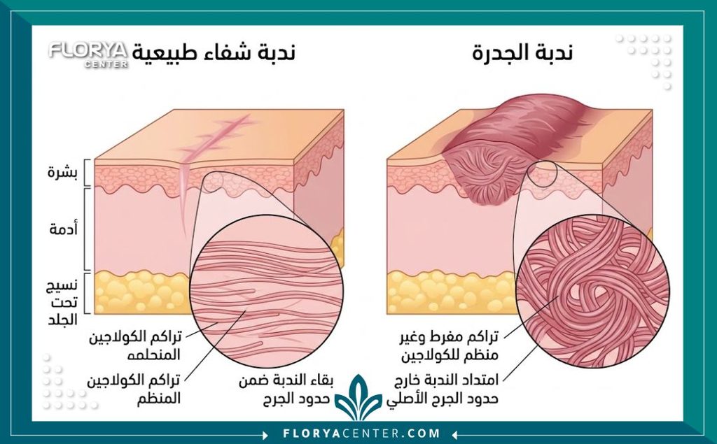 رسم توضيحي طبي لطبقات الجلد يوضح الفرق بين الندبة الطبيعية وتكون الكيلويد أو الندبة اللحمية البارزة.