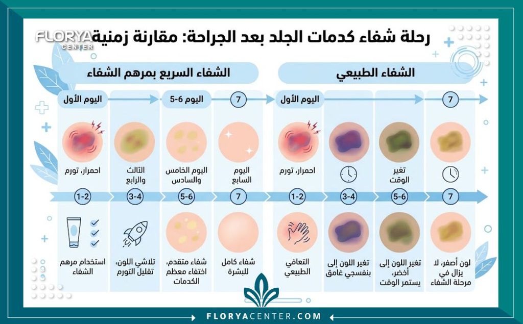 إنفوجرافيك يوضح مراحل ومدة اختفاء الكدمات الزرقاء بعد عملية نحت الجسم.