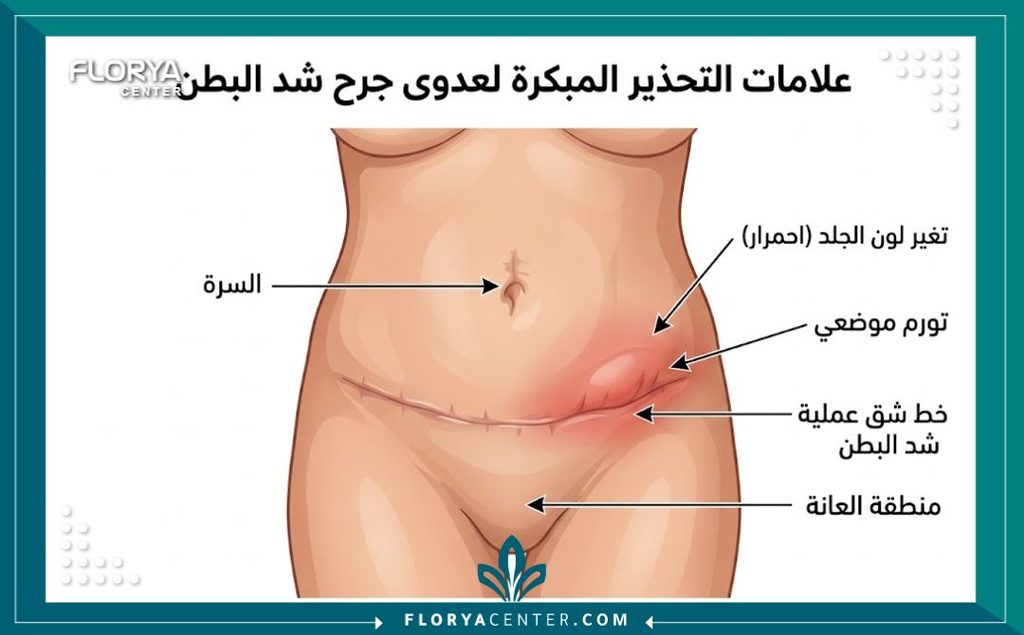 رسم توضيحي طبي يوضح تشريح منطقة البطن ومكان ظهور علامات التهاب الجرح مثل الاحمرار والتورم بعد الجراحة.
