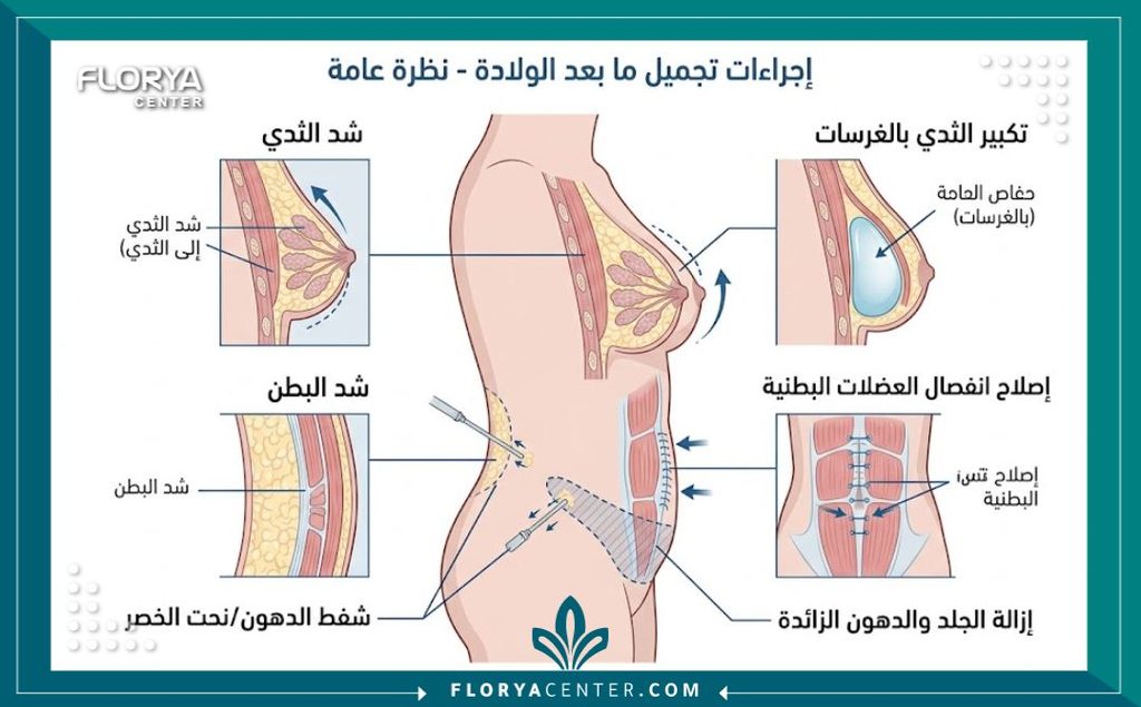 رسم طبي توضيحي يشرح الإجراءات الجراحية في المامي ميك أوفر من شد البطن ورفع الثدي.