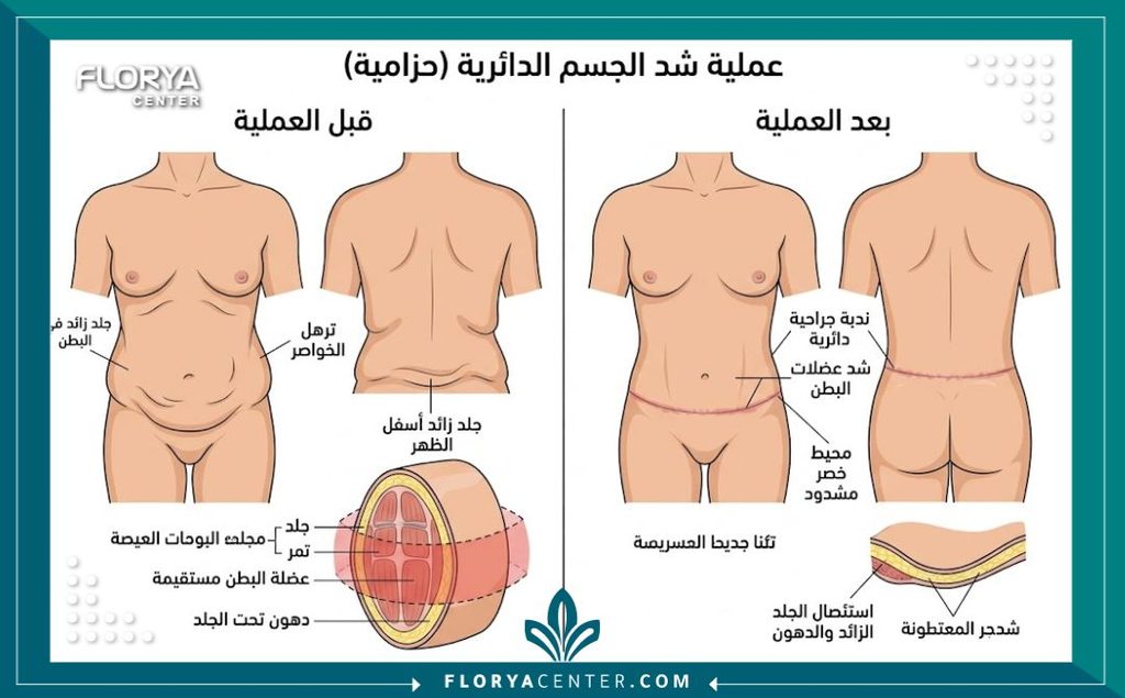 رسم توضيحي طبي لخطوات عملية استئصال الجلد الزائد من الجذع بالكامل وشد الظهر والبطن.