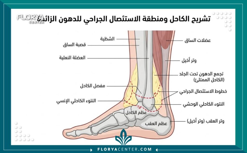 رسم توضيحي طبي يظهر تشريح منطقة أسفل الساق ومناطق تراكم الجلد المترهل قبل عملية تجميل الكاحل.