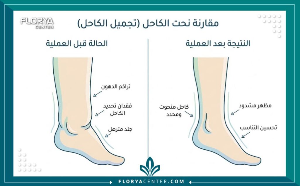 إنفوجرافيك يقارن بين شكل الساق قبل وبعد عملية استئصال الجلد الزائد من الكاحل لعلاج ترهلات أسفل الساق الشديدة.