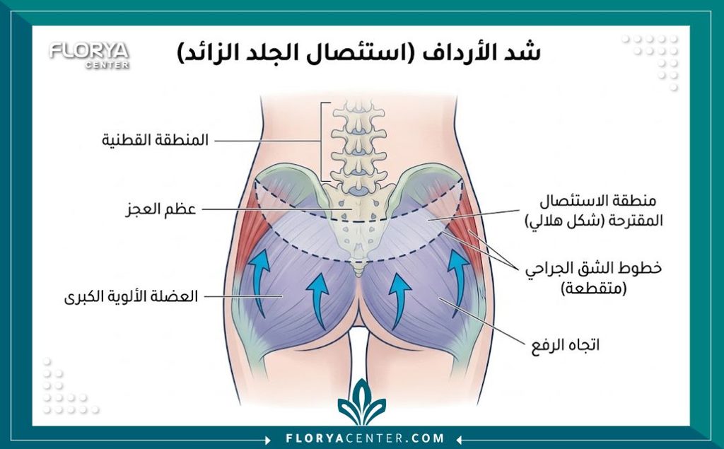 رسم توضيحي طبي تشريحي يبين تقنية استئصال الجلد المترهل من أعلى المؤخرة لرفعها وشدها جراحياً.