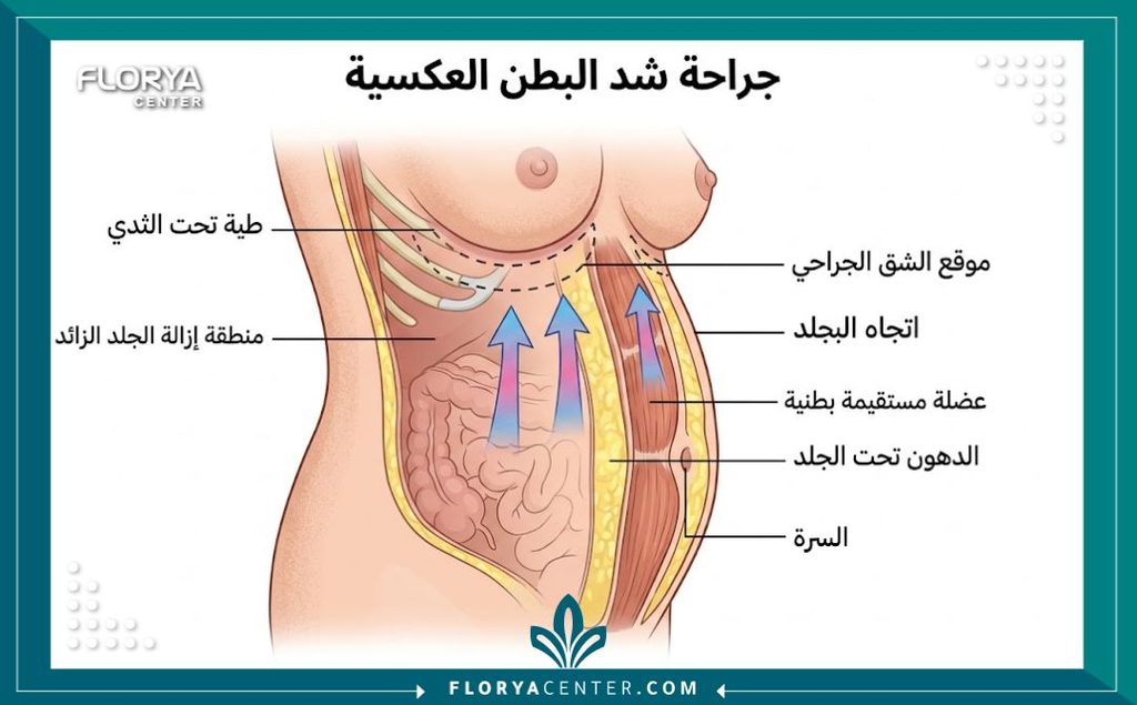 رسم توضيحي طبي يشرح تشريح وتقنية عملية شد البطن العكسي، يوضح سحب الجلد للأعلى مع إخفاء الجرح تحت الثديين.