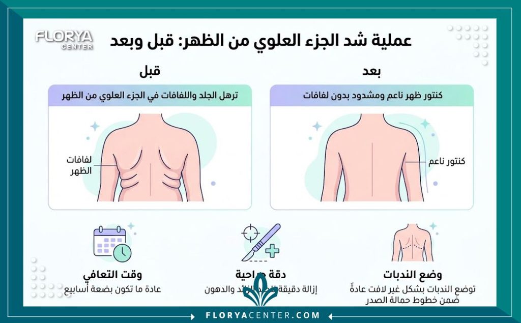 إنفوجرافيك يوضح خطوات ومميزات عملية شد الظهر العلوي والفرق في الترهلات قبل وبعد الجراحة.