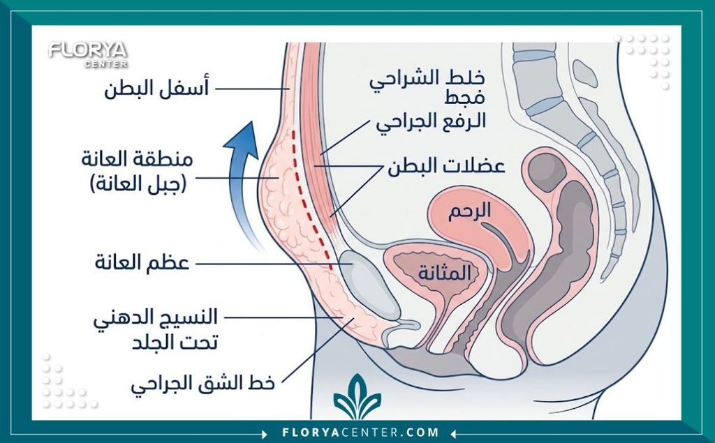 رسم طبي تشريحي يوضح كيفية رفع وقص الجلد المتدلي والسميك فوق الأعضاء التناسلية في جراحة شد العانة.