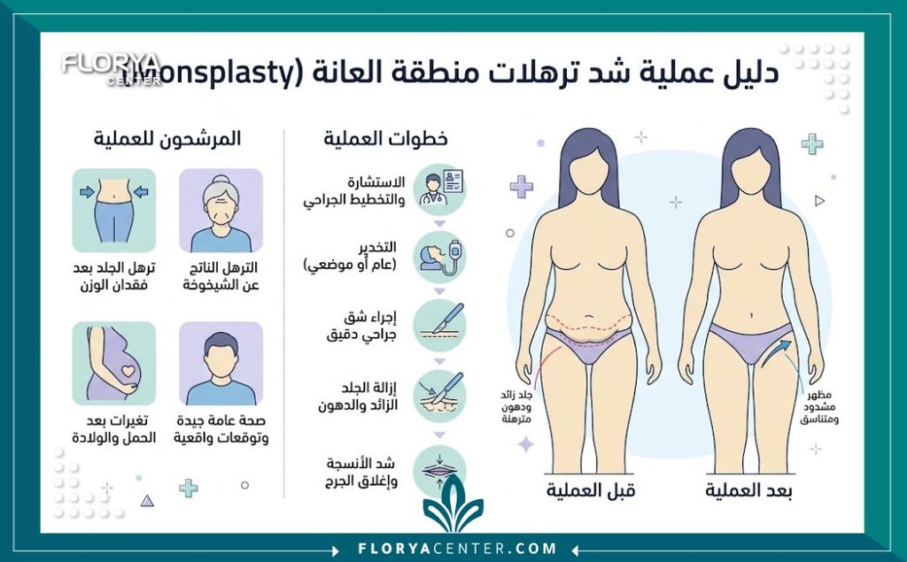إنفوجرافيك يوضح مقارنة لخطوات ونتائج ما قبل وما بعد عملية إزالة ترهلات منطقة العانة الجراحية (Monsplasty).