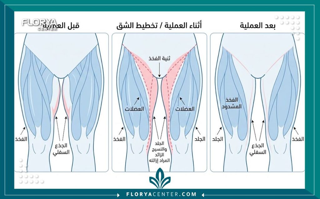 رسم توضيحي طبي يوضح أماكن الشقوق الجراحية في عملية شد الفخذين من الداخل لإزالة الجلد المترهل.