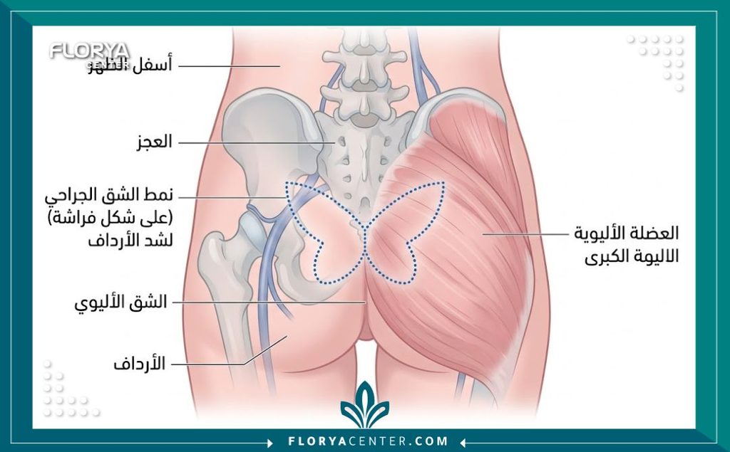 عملية شد المؤخرة الفراشية (Butterfly Butt Lift) 2 رسم توضيحي طبي تشريحي يبين شكل الشق الجراحي على هيئة فراشة في عملية شد المؤخرة الفراشية لرفع الجلد المترهل.