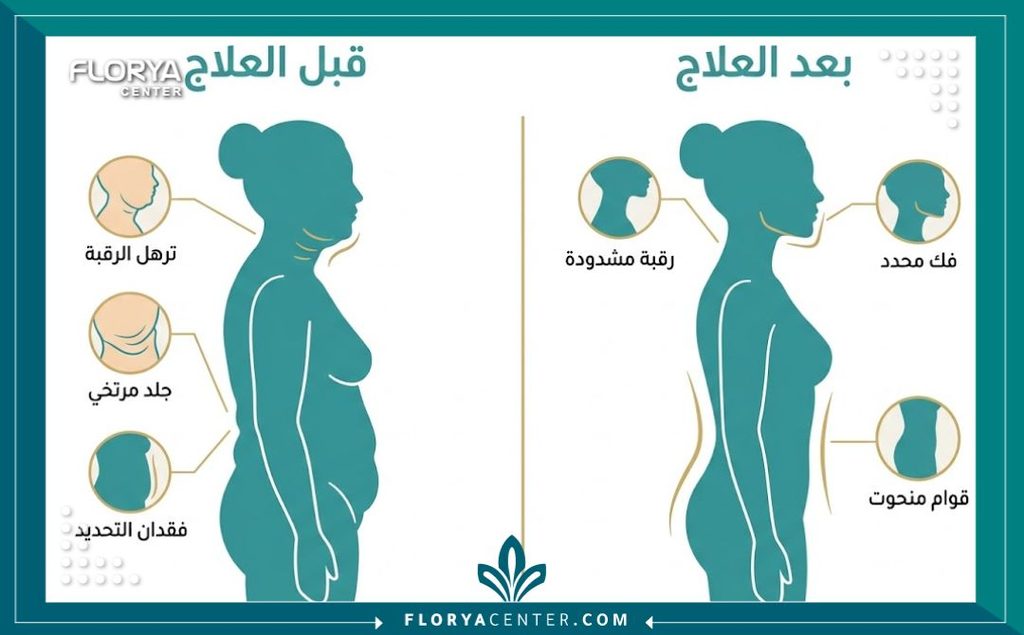 إنفوجرافيك يقارن بين حالة الجسم واللغلوغ قبل وبعد عملية شد ترهلات الرقبة العميقة كجزء أساسي من جراحة شد القوام الشامل.