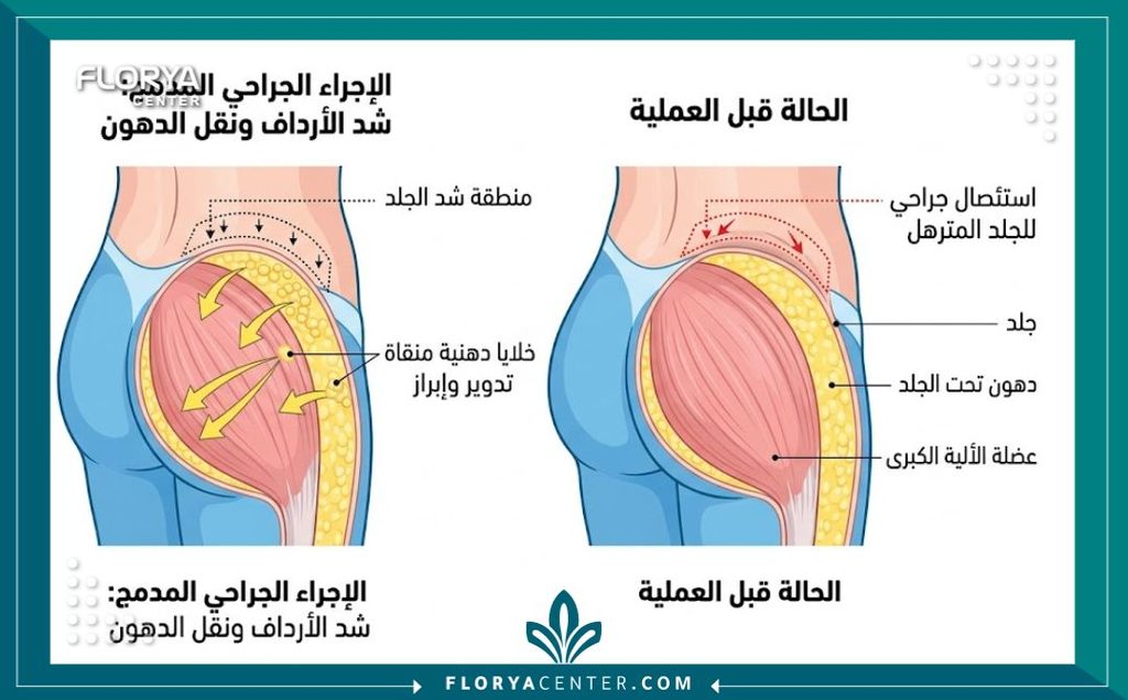 رسم توضيحي طبي لخطوات ومراحل عملية شد الأرداف مع حقن الدهون الذاتية لتدوير المؤخرة.