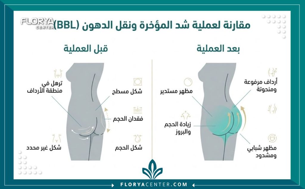 إنفوجرافيك يقارن بين شكل الجسم قبل وبعد عملية شد وتدوير الأرداف والتخلص من الترهلات.