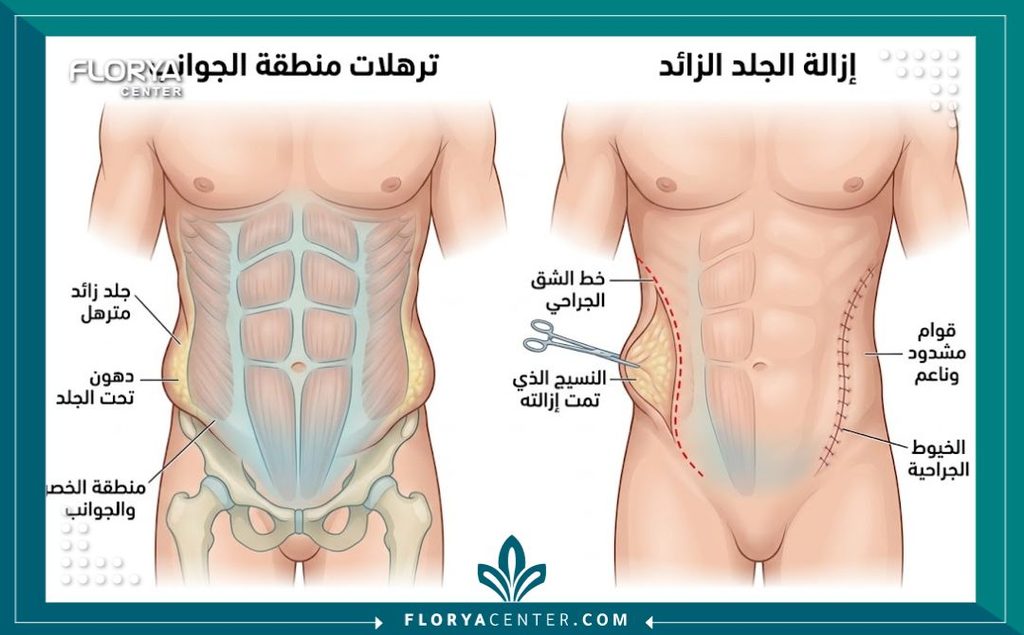 رسم توضيحي طبي لتشريح منطقة الخصر يوضح كيفية استهداف الجيوب الجلدية المتدلية في عملية شد الجوانب.