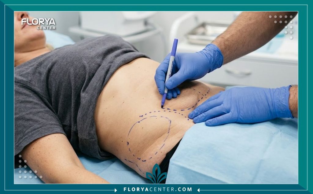 طبيب جراحة تجميل يقوم بتخطيط منطقة الجوانب وتحديد الجيوب الجلدية المترهلة قبل إجراء الفلانك بلاستي.