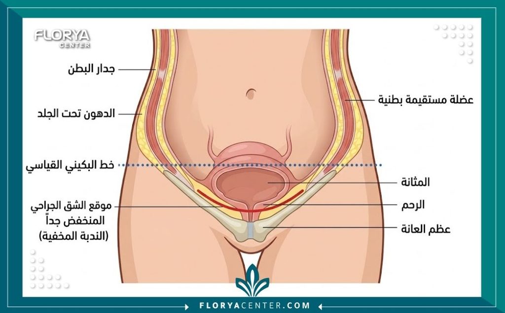 رسم توضيحي طبي يحدد بدقة موقع شق عملية قص الجلد المخفية أسفل خط البكيني لضمان إخفاء الندبة بالكامل.