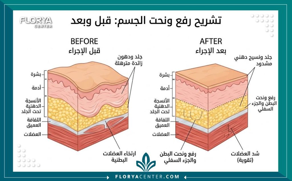 رسم توضيحي طبي لطبقات الجلد والعضلات يوضح الفرق قبل وبعد عملية شد الجسم المترهل.