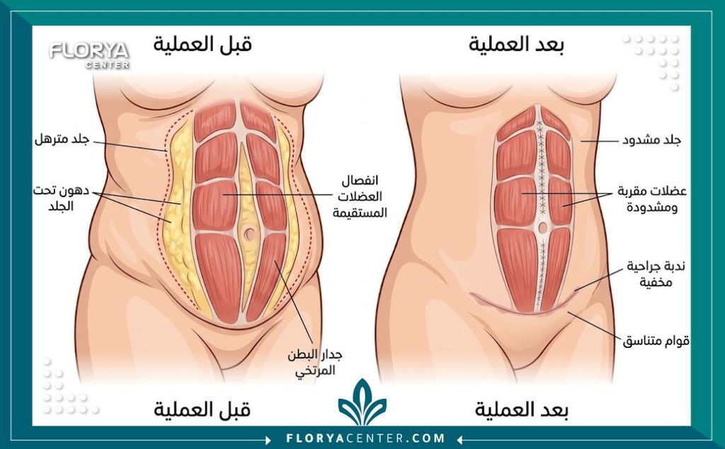 رسم توضيحي طبي لطبقات البطن يوضح كيفية جراحة قص الجلد المترهل وإزالة الفائض الجلدي.