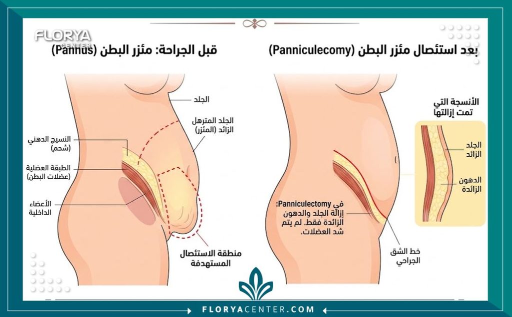 رسم طبي توضيحي يبين طبقات الجلد المترهل الذي يتم إزالته أثناء عملية شد البطن وقص الجلد.