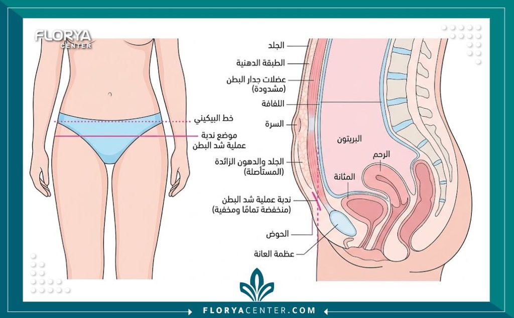 رسم توضيحي طبي لموقع جرح عملية شد البطن السفلي وكيفية اختفائه تحت خط البكيني.