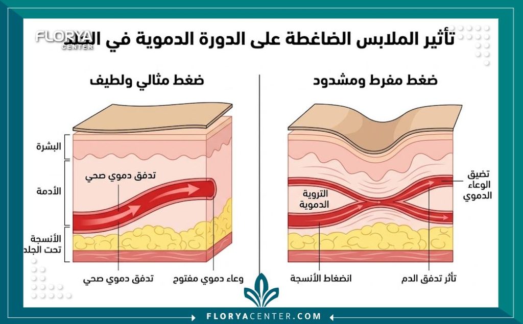 كيف أختار المشد المناسب بعد العملية 2 رسم توضيحي طبي يوضح الفرق بين الضغط الصحيح والمفرط للمشد بعد العملية لتجنب نخر الأنسجة.