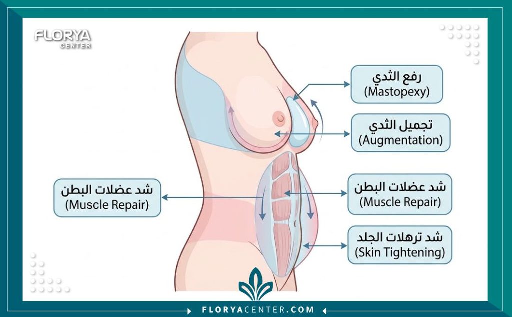رسم توضيحي طبي يوضح الإجراءات الشاملة في عملية مامي ميك اوفر مثل شد البطن وإصلاح الانفصال العضلي ورفع الثدي.