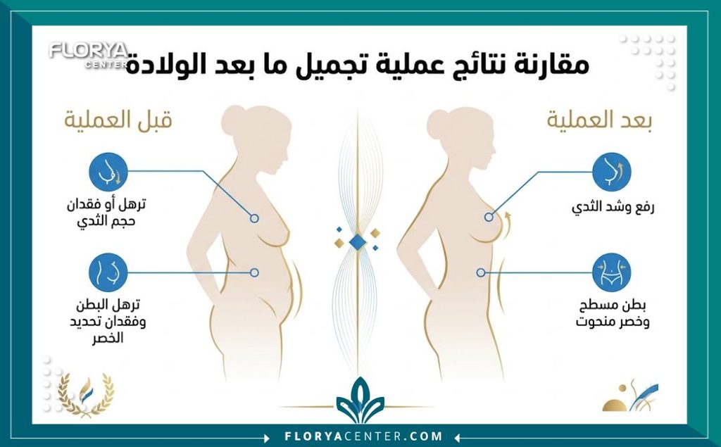 إنفوجرافيك يقارن شكل الجسم قبل وبعد عملية المامي ميك اوفر ويوضح فوائد تجميل ما بعد الولادة.