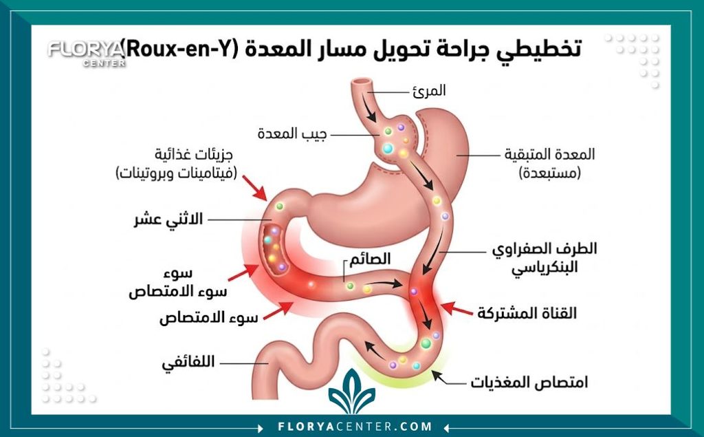 رسم توضيحي طبي يشرح ما هي متلازمة سوء الامتصاص بعد جراحات السمنة وتأثيرها على نقص الفيتامينات.