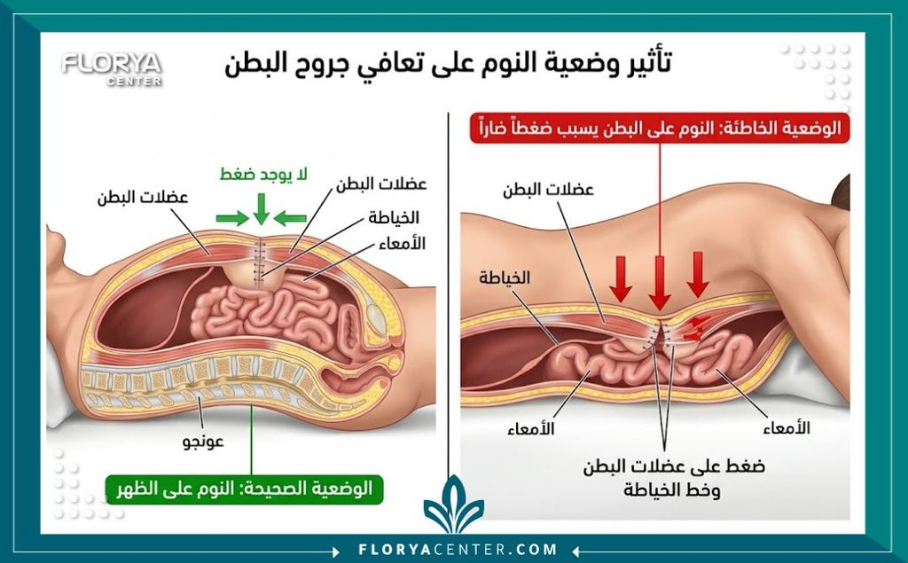 رسم توضيحي طبي يبين مناطق الضغط وتأثير النوم على البطن قبل مرور شهرين على جراحة الشد.