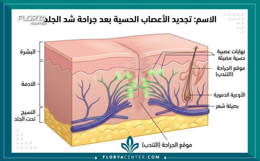 رسم توضيحي طبي ثلاثي الأبعاد يوضح كيفية تجدد الأعصاب السطحية تحت الجلد وعودة الإحساس بعد جراحة الشد.