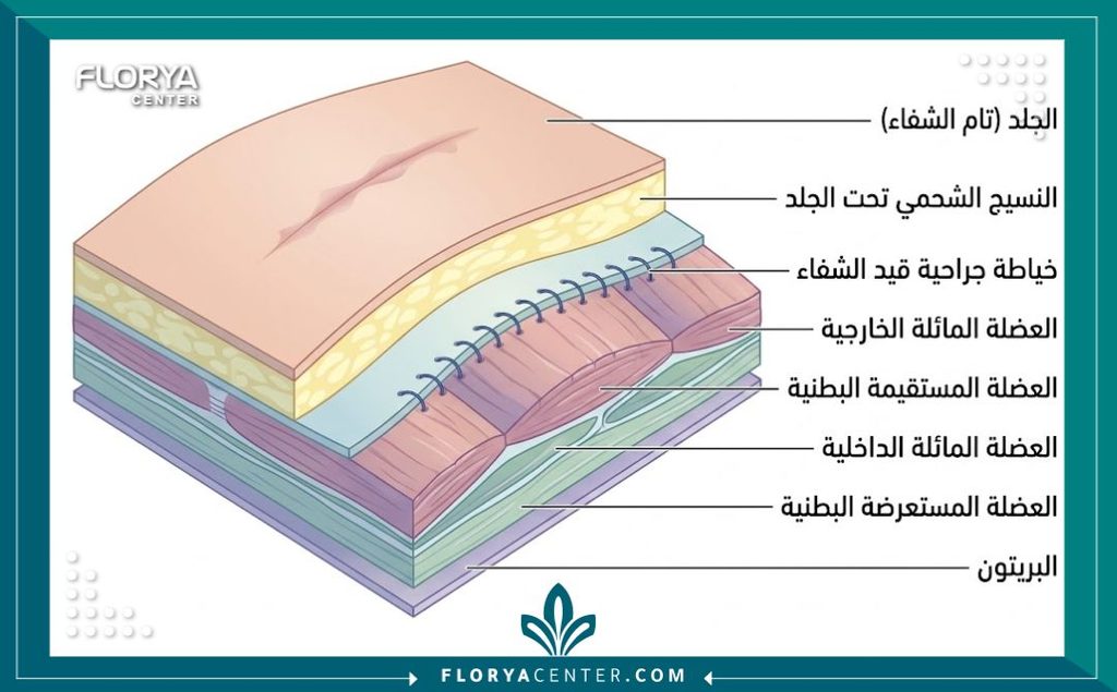 رسم توضيحي طبي يوضح الفرق بين التئام الجرح الخارجي وشفاء العضلات الداخلية بعد عملية شد البطن وشد العضلات.