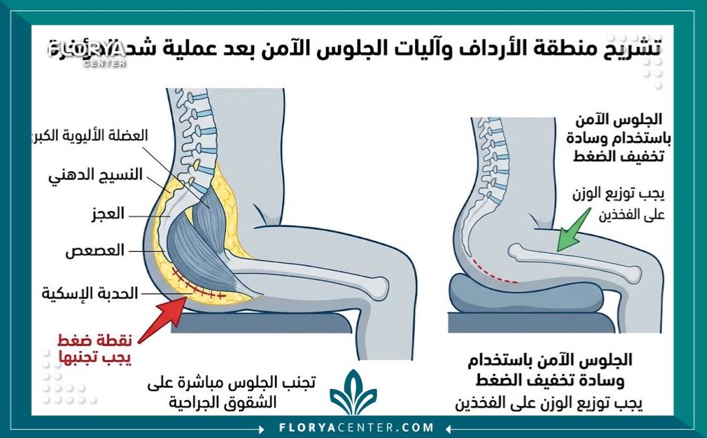 رسم توضيحي طبي يوضح أماكن الضغط التي يجب تجنبها لحماية الجرح عند الجلوس بعد عملية شد المؤخرة.