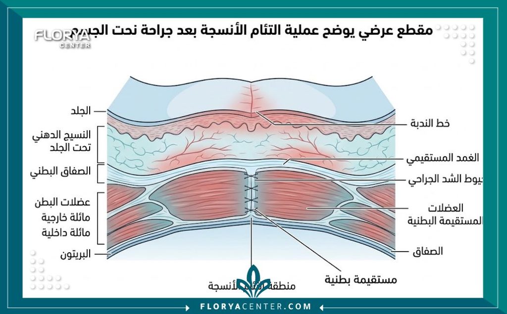 رسم توضيحي طبي يوضح مراحل التئام العضلات والجلد بعد جراحة شد الترهلات وأهمية تجنب الإجهاد المبكر.