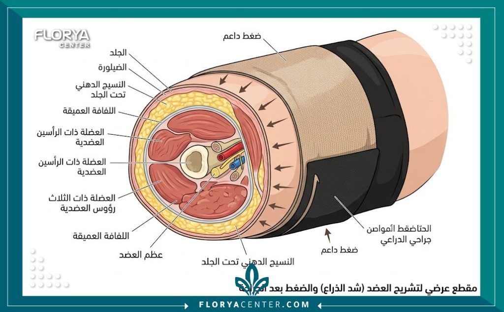 مدة لبس المشد بعد عملية شد الزنود 2 رسم طبي يوضح تأثير الضغط والدعم على الأنسجة خلال مدة لبس المشد بعد عملية شد الزنود لضمان أفضل نتيجة.