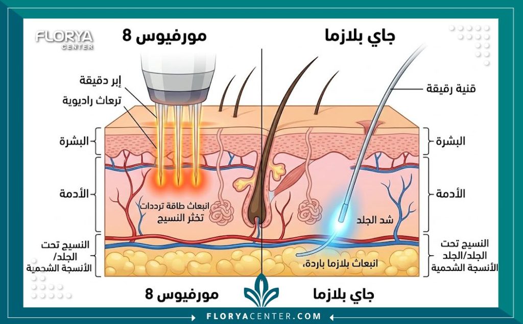 رسم توضيحي طبي يوضح الفرق بين عمل المورفيوس الخارجي والجي بلازما الداخلي لشد الترهلات