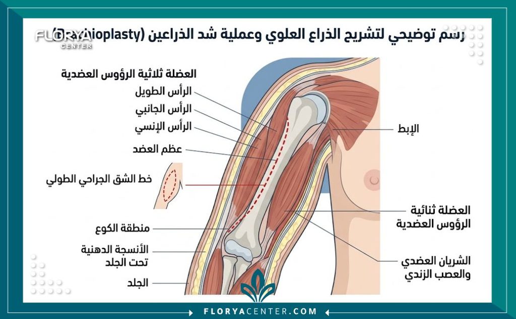 رسم توضيحي طبي يوضح مكان الندبة الطولية المخفية في عملية شد الزنود الجراحية.