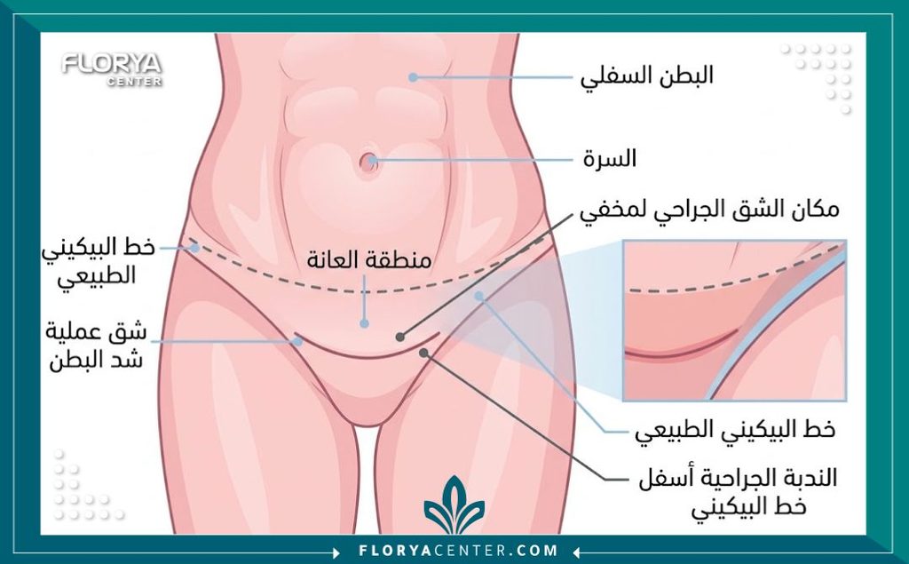 ندبة شد البطن 2 رسم طبي يوضح مكان ندبة شد البطن أسفل خط البكيني لسهولة إخفائها تحت الملابس.