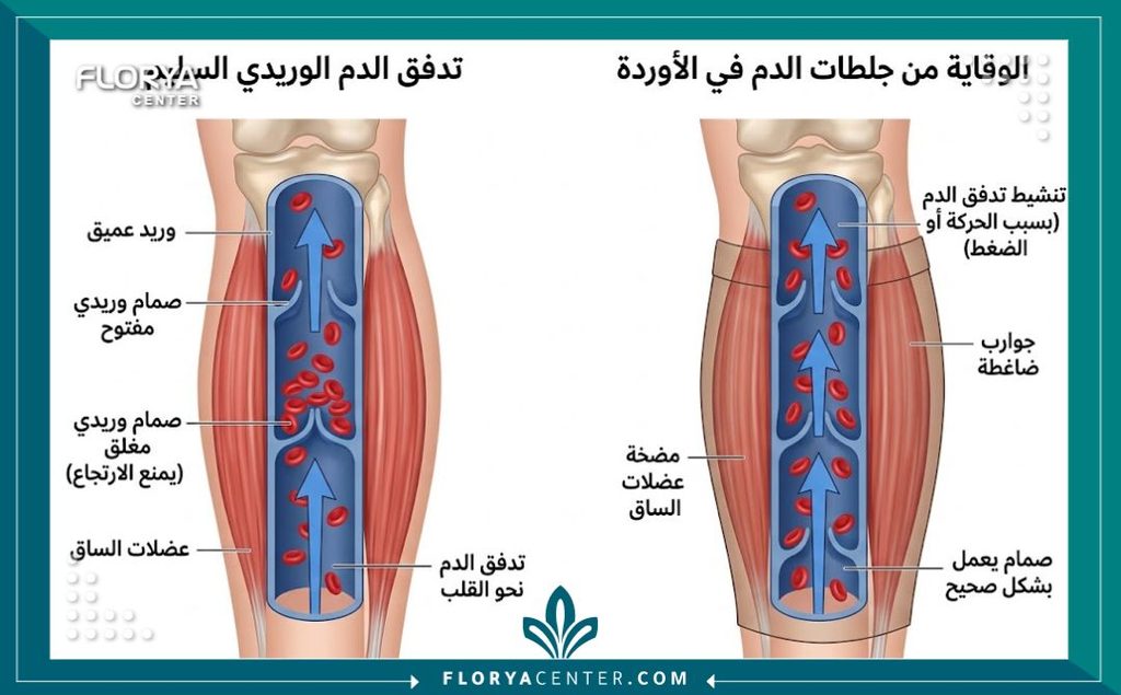 رسم توضيحي طبي ثلاثي الأبعاد يوضح تدفق الدم السليم في أوردة الساقين وأهمية الوقاية لمنع تكون الجلطات الدموية بعد العمليات الجراحية.