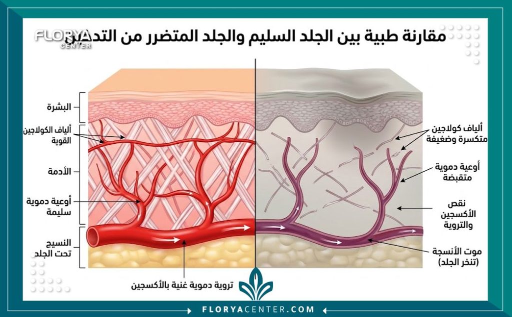 رسم توضيحي طبي يوضح الفرق بين تدفق الدم في الجلد السليم ومخاطر نخر الجلد بسبب التدخين.