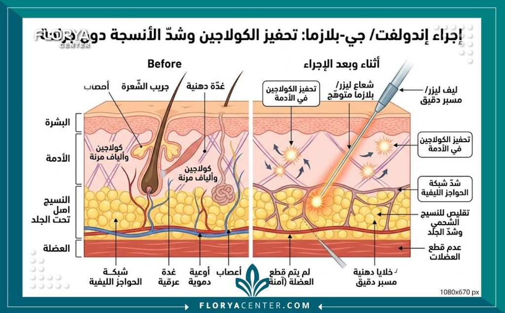 هل الليزر يشد ترهلات البطن 2 رسم طبي توضيحي يبين كيف يعمل جهاز الاندوليف والجي بلازما على شد الجلد وتحفيز الكولاجين في البطن.